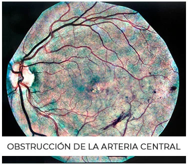 Obstrucción de arteria central
